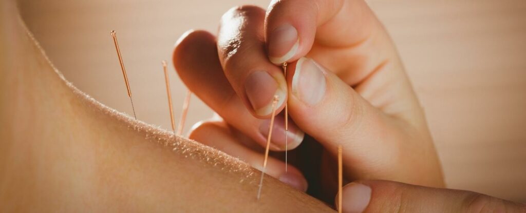 does medicare cover acupuncture? only for one condition.