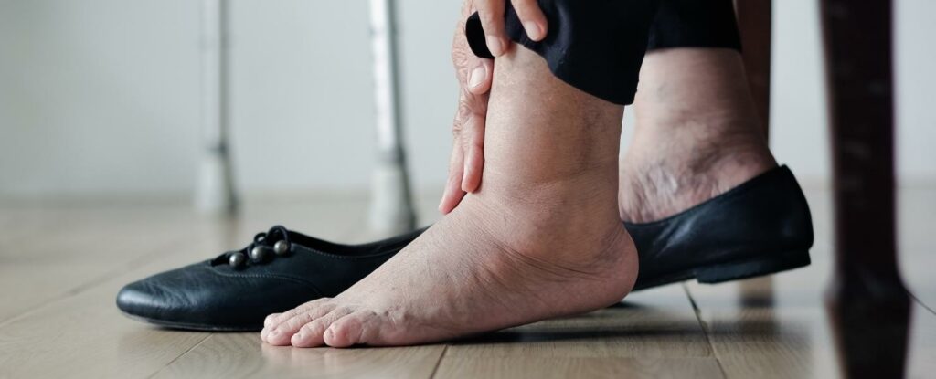 what is ankle swelling