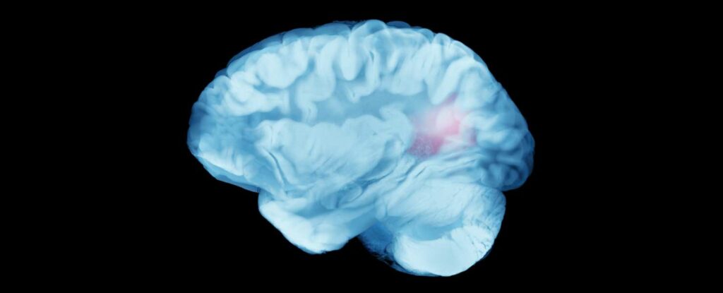 image of an xray of a Hemorrhagic Stroke