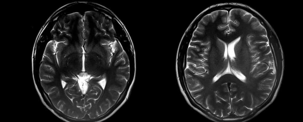 brain scans - types of dementia