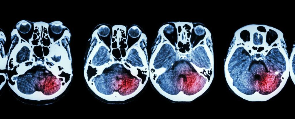 images of brain with stroke