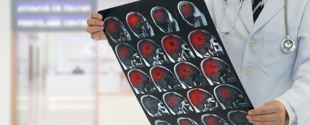 doctor holding image portraying the different types of strokes